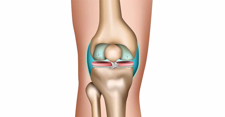 Einrisse und breite Auffaserungen des Kniegelenkknorpels. Erstes Auftreten von Osteophyten möglich.